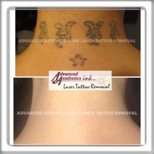 Advanced Aesthetics Ink | Massachusetts Laser Tattoo Removal